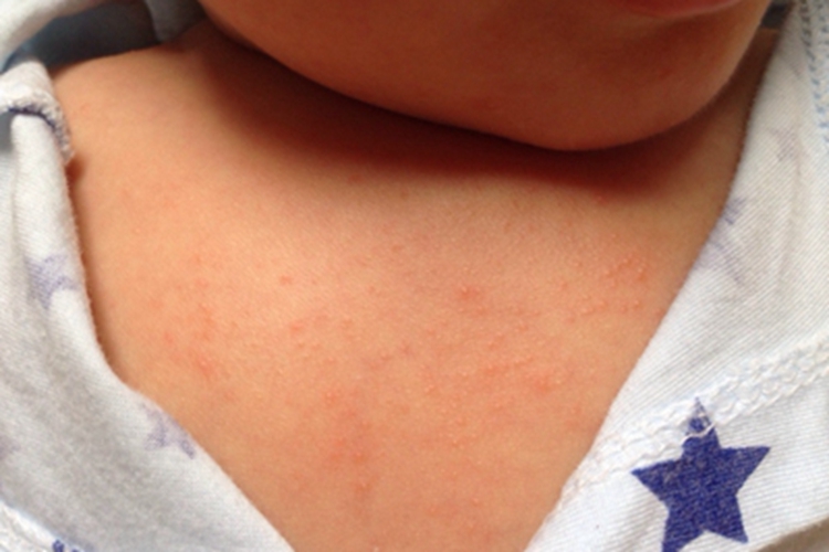 红痱前胸一片小红疙瘩图