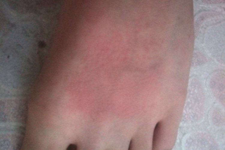 植物光皮炎脚背红斑图