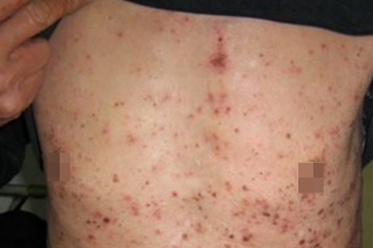 脓毒败血症疹胸部血痂图