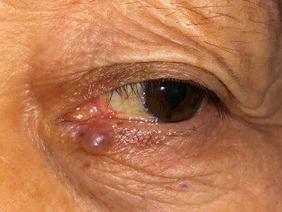 眼睑皮脂腺癌下眼睑长了个圆形硬疙瘩图