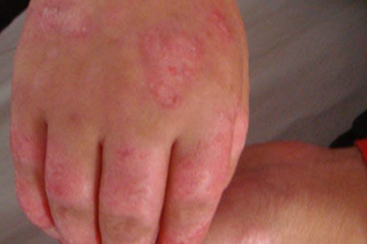 盘状红斑狼疮手背红斑图