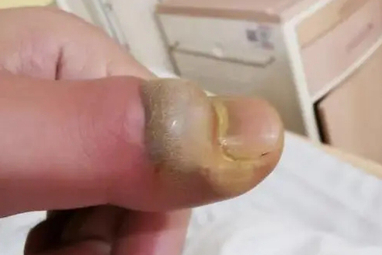 手部感染脓肿图