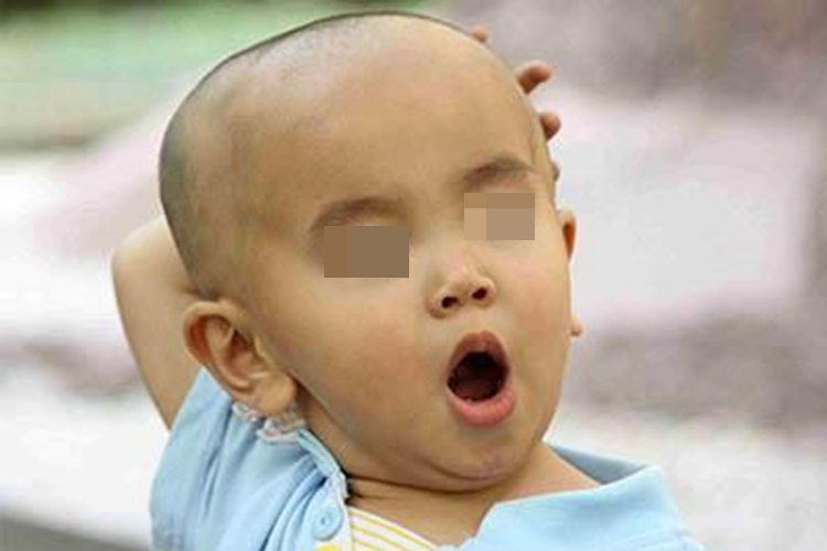 佝偻病方颅图 佝偻病方颅图