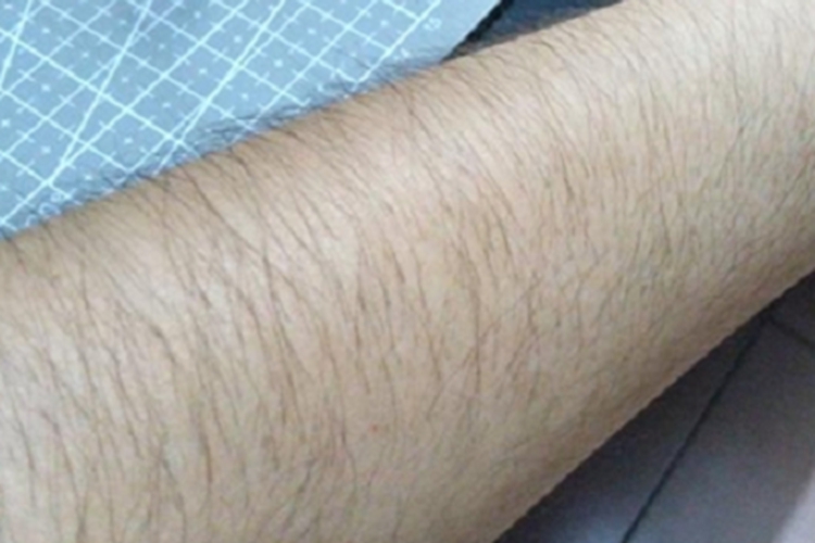女性多毛症胳膊症状图