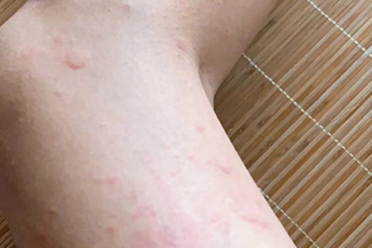荨麻疹型药疹大腿小红疙瘩图 荨麻疹型药疹大腿小红疙瘩图