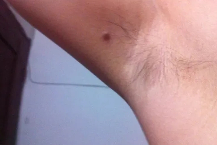 腋下扁平疣图 腋下扁平疣图