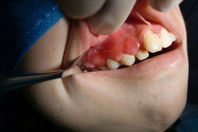 牙龈瘤上牙龈多处红肿图