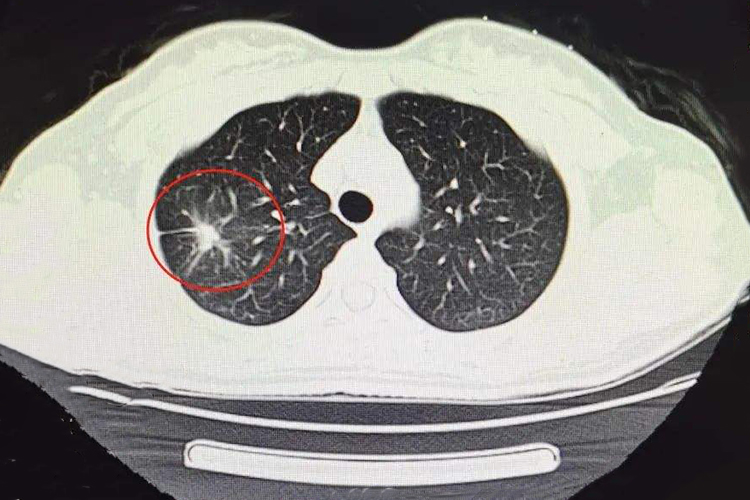 肺结核治好后的疤痕图