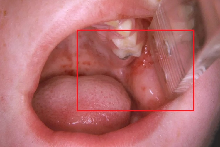 腮腺炎颊黏膜水肿图 腮腺炎颊黏膜水肿图
