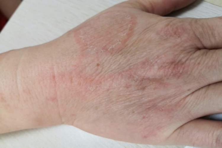 体癣手背有丘疹和鳞屑图