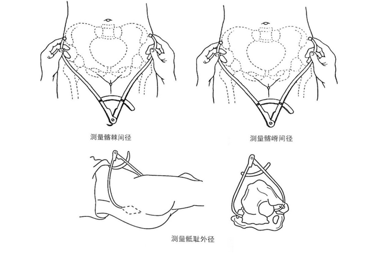骼嵴间径、骶耻外径测量图