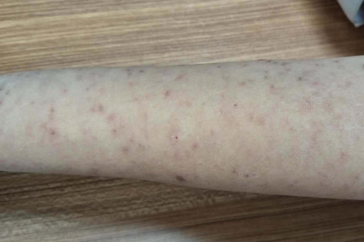 副银屑病小腿斑图