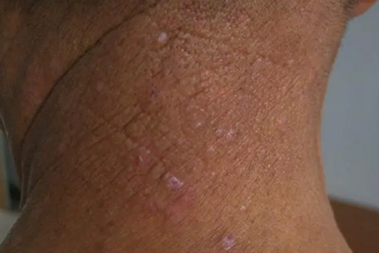 苔藓样淀粉样变病颈部后面丘疹图