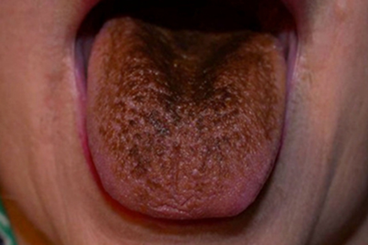 黑毛舌舌头发黑图