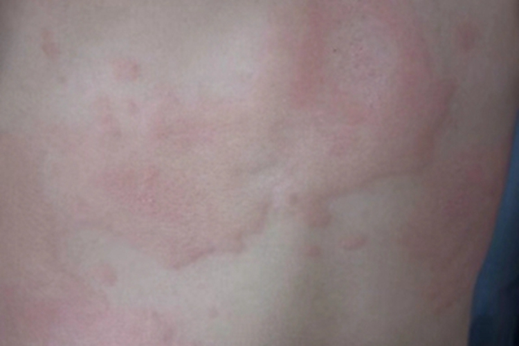 急性自发性荨麻疹胸部症状图