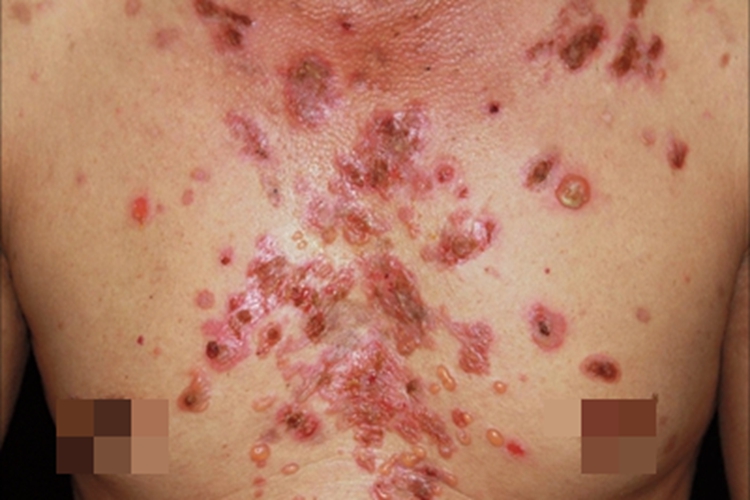 寻常型天疱疮水疱图