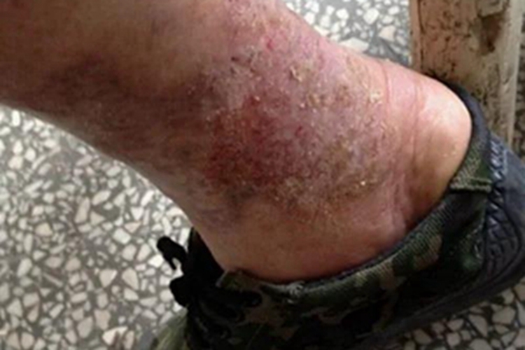 急性湿疹脚踝症状图 急性湿疹脚踝症状图