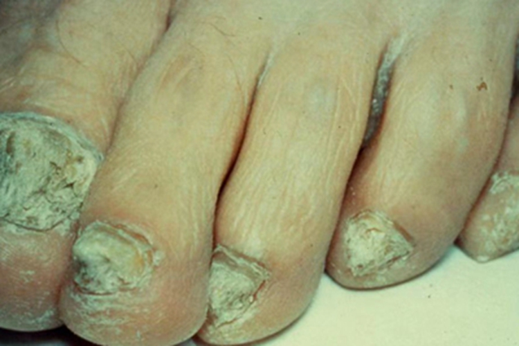 银屑病甲脚趾甲变形图