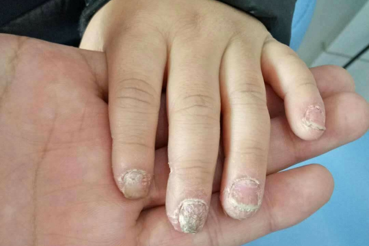 甲念珠感染甲板变浑浊图 甲念珠感染甲板变浑浊图