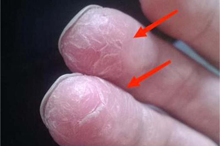 甲状腺功能减退症手指皮肤增厚图