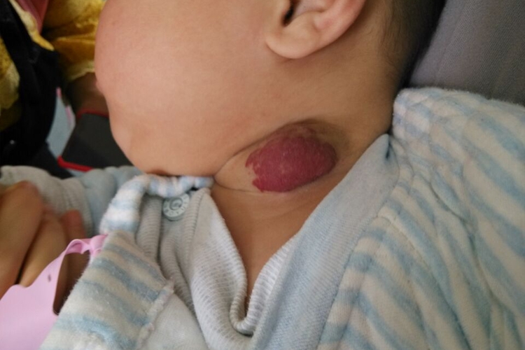 婴儿颈部鲜红斑痣图