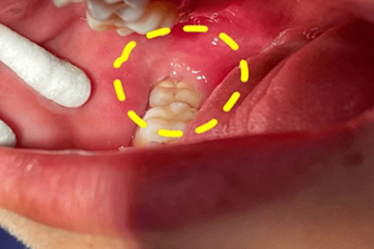 智齿冠周炎牙龈症状图 智齿冠周炎牙龈症状图