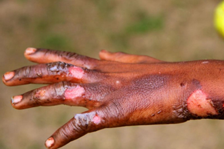 低压电烧伤手背皮肤发黑图 低压电烧伤手背皮肤发黑图