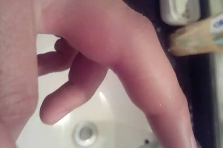 蚊虫叮咬皮炎图