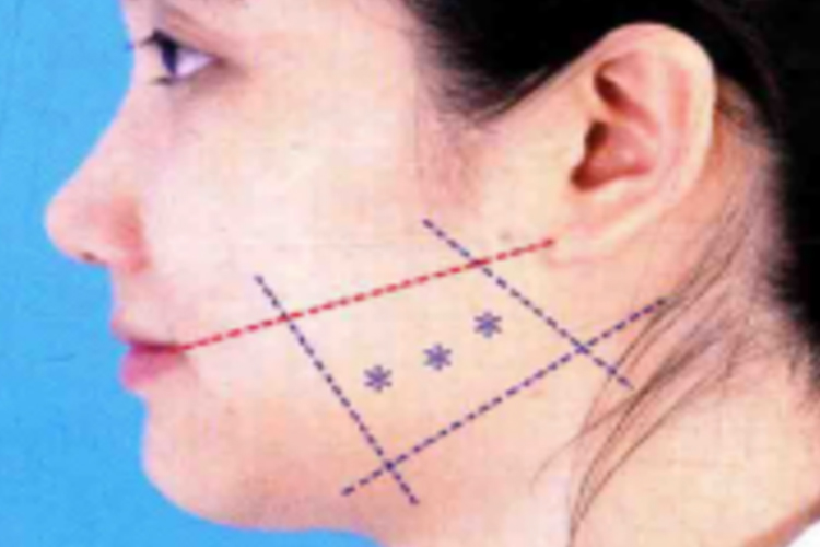 打瘦脸针三个点位置图