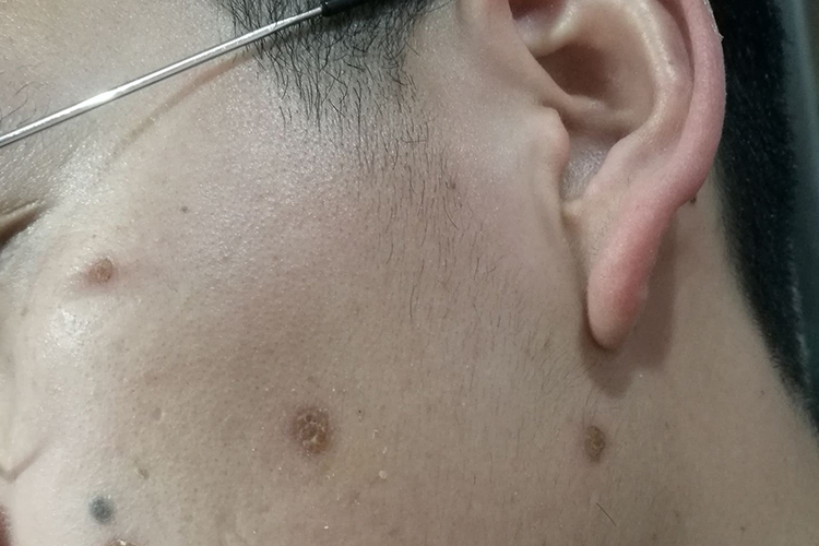 面部点痣图 面部点痣图