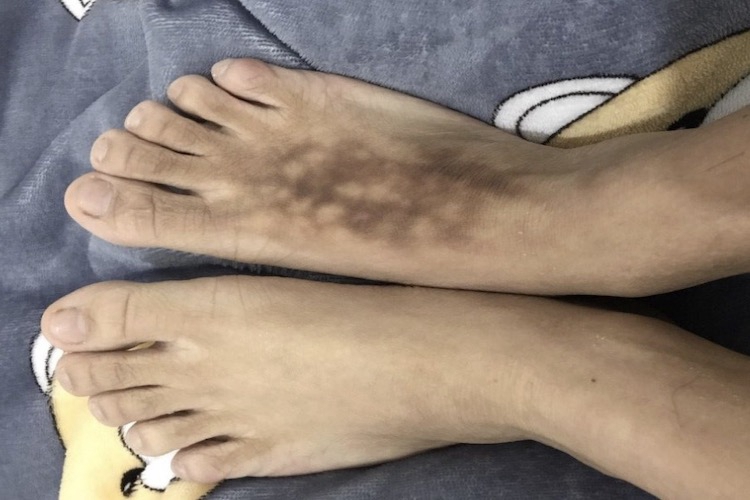 慢性期硬化性脂膜炎脚背发黑图