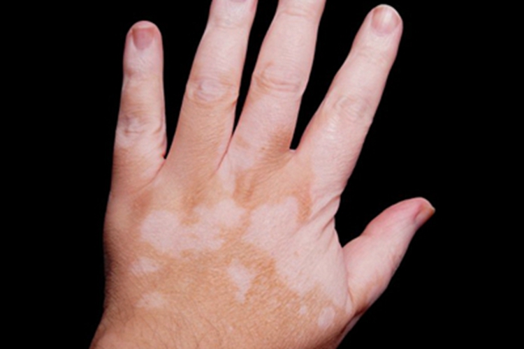 白癜风手部皮肤颜色变浅图
