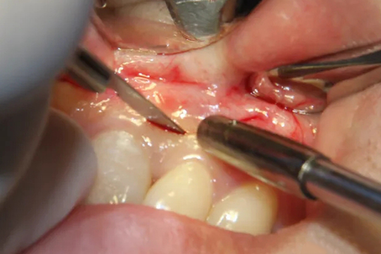 牙根囊肿做手术切口图 牙根囊肿做手术切口图