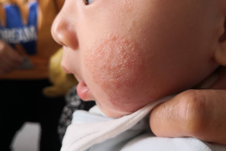 特应性皮炎图 特应性皮炎图