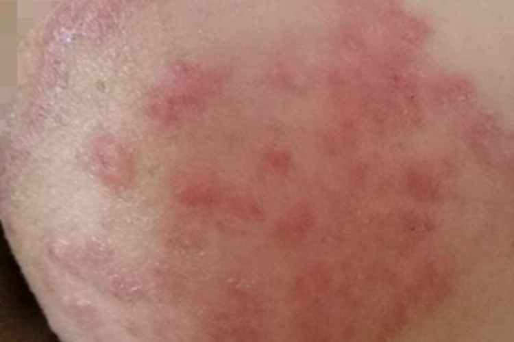 妊娠多形疹腹部红斑图