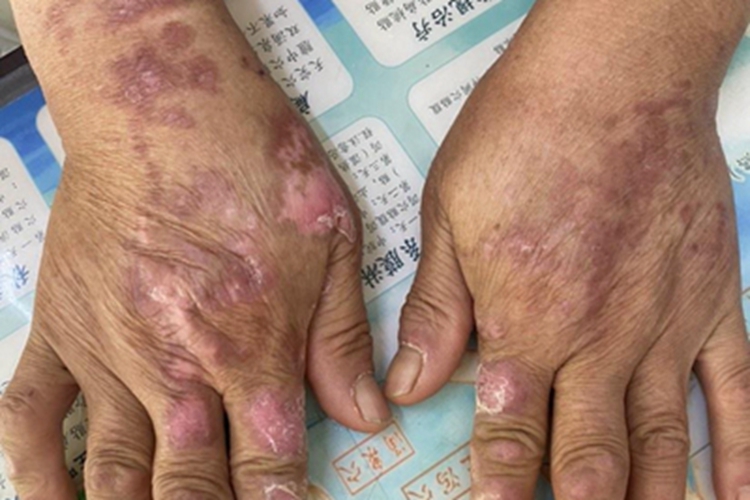 硬红斑手背脱皮粉色图