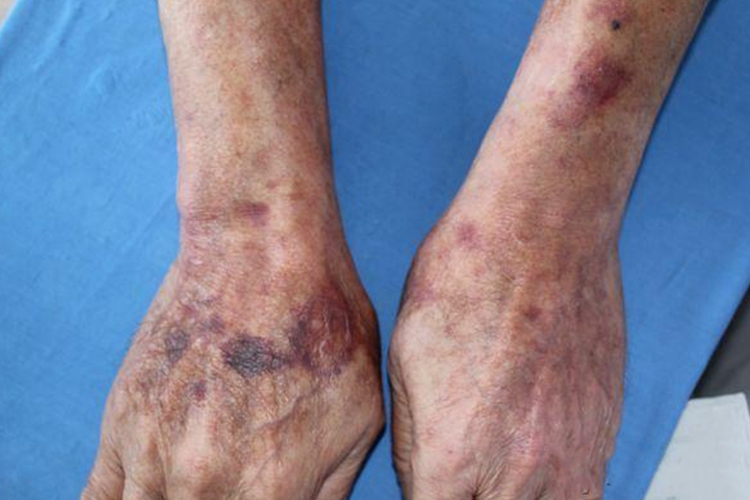 手臂紫癜大小不等图 手臂紫癜大小不等图