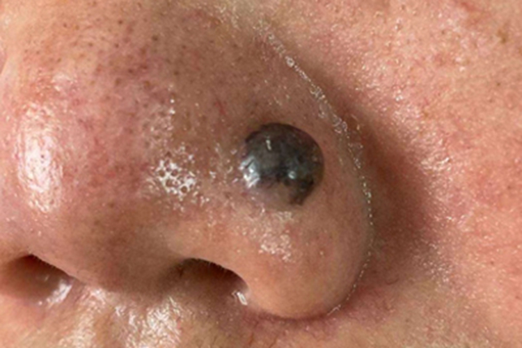 结节型基底细胞瘤鼻翼圆疙瘩图