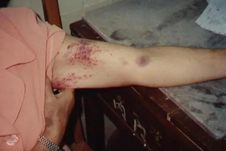 血小板减少性紫癜胳膊血点图