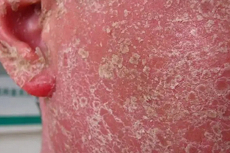 红皮病脱屑期面部脱屑图