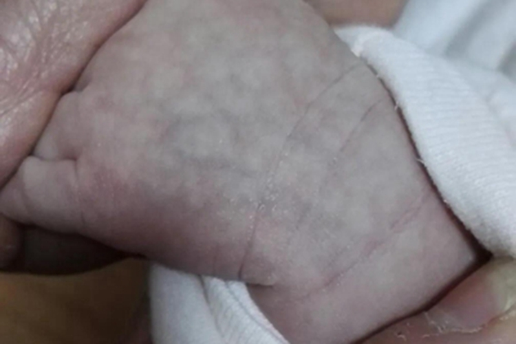 儿童结节性多动脉炎手背条纹图