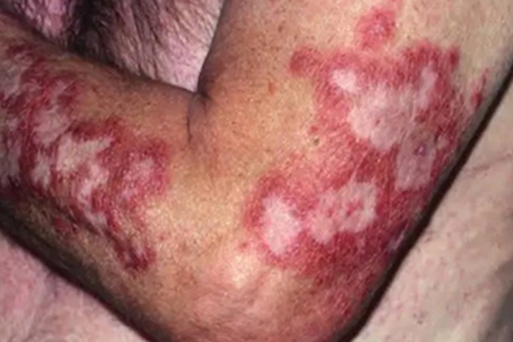 红斑狼疮胳膊症状图