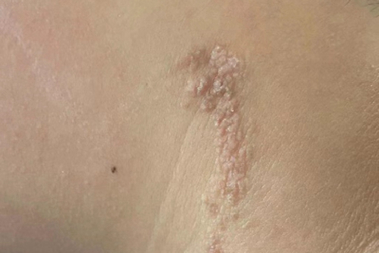 线状疣状表皮痣侧颈症状图 线状疣状表皮痣侧颈症状图