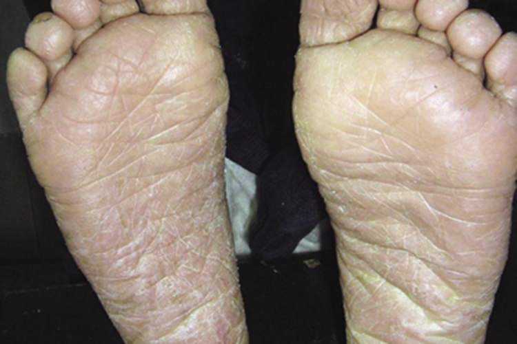 条纹状掌跖角化病症状图
