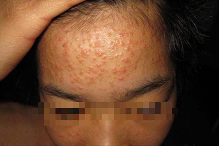马拉色菌毛囊炎前额症状图