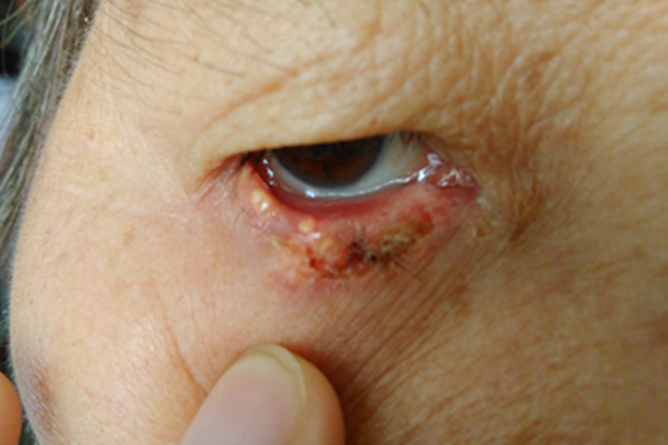 结节型基底细胞瘤眼睑结痂图