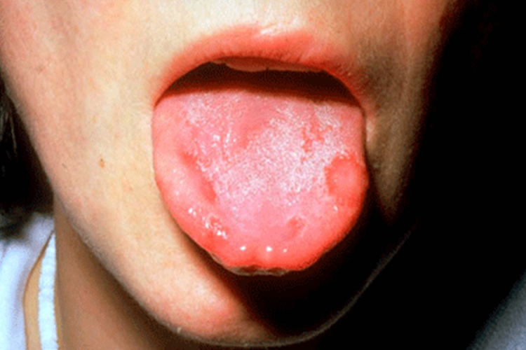 地图舌图 地图舌图