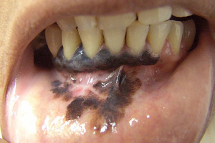 口腔颌面部恶性黑色素瘤黑斑图