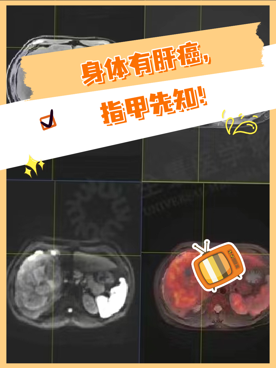 身体有肝癌，指甲先知！