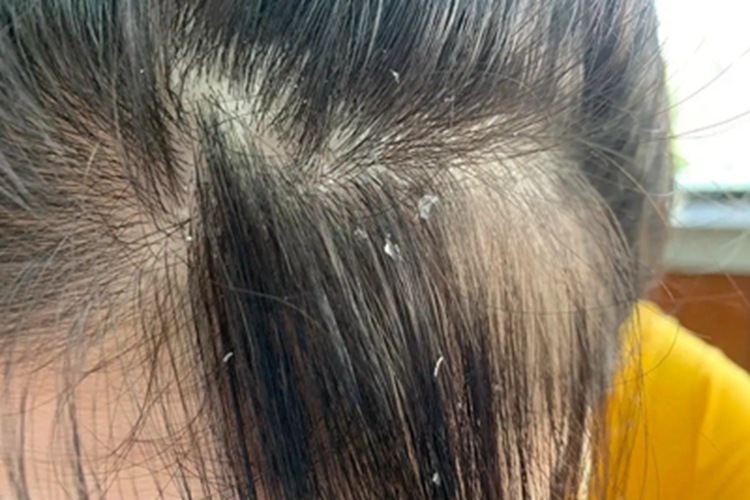 头皮糠疹头皮症状图